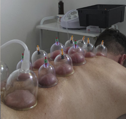 Trattamento di Coppettazione